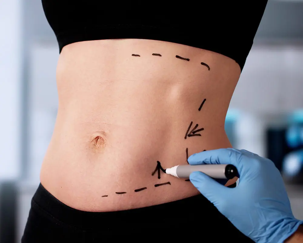 Liposuction | Liposuction Cost | What is Liposuction | Liposuction UK