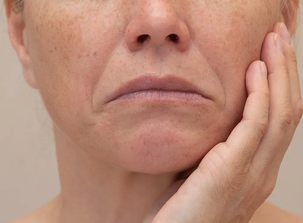 Sagging Jowls | Sagging Jowls Treatment | How to Tighten Up Sagging Jowls