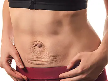 Diastasis Recti | Diastasis Recti Surgery | Diastasis Recti Before and After