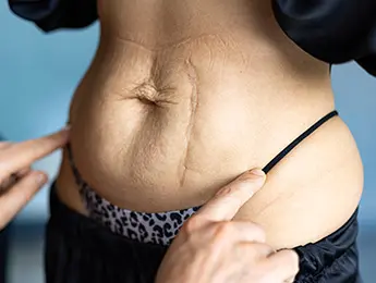 Loose Abdominal Skin | Sagging Stomach