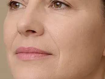 Nasolabial Folds | Nasolabial Folds Treatment | What Are Nasolabial Folds