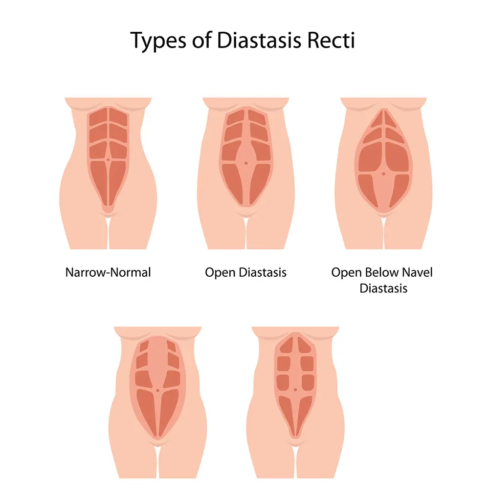 Diastasis Recti | Diastasis Recti Surgery | What is Diastasis Recti