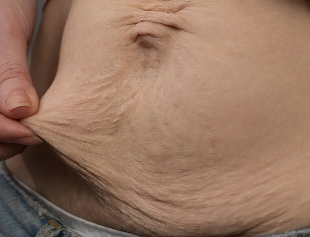 Loose Abdominal Skin | Sagging Stomach