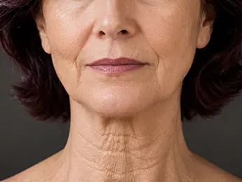 Platysmal Bands | Platysmal Bands Treatment | Platysmal Neck Bands