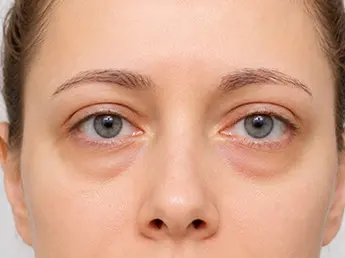bags under eyes, bags under eyes treatment, dark bags under eyes