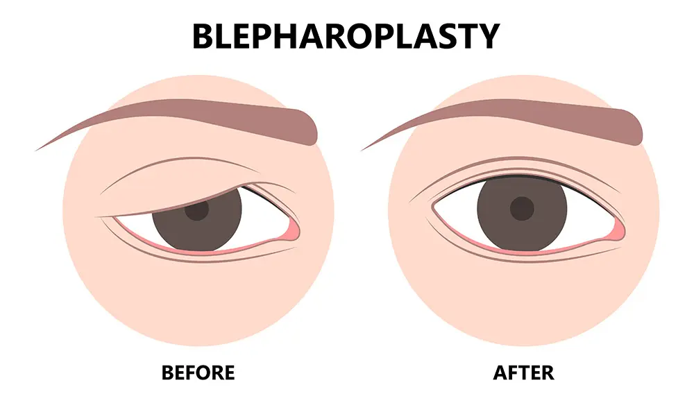 Hooded Eyelids | Hooded Eyelids Surgery | Hooded Eyelids Treatment