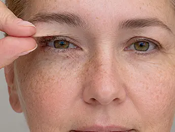 Hooded Eyelids | Hooded Eyelids Surgery | What Are Hooded Eyelids