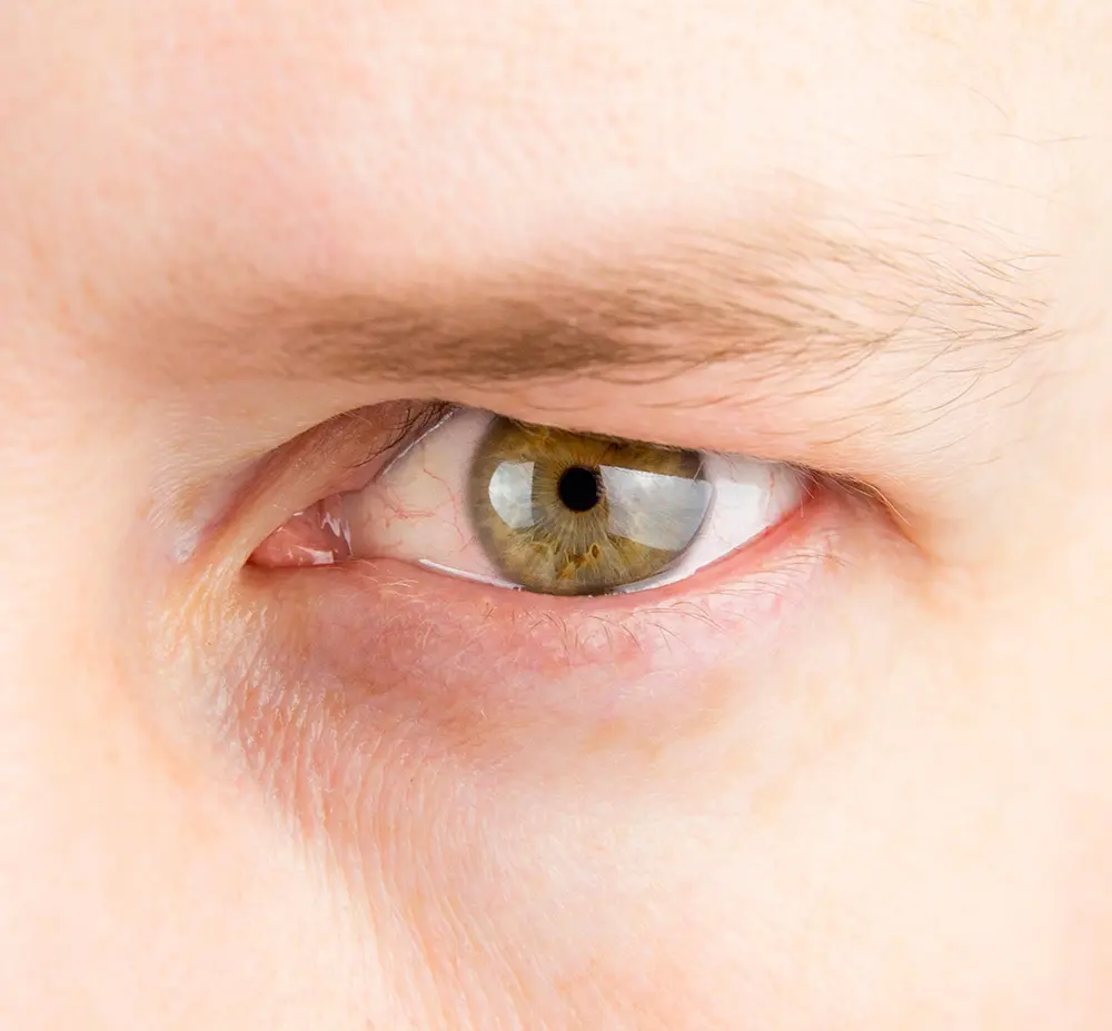 Hooded Eyelids | Hooded Eyelids Surgery | What Causes Hooded Eyelids
