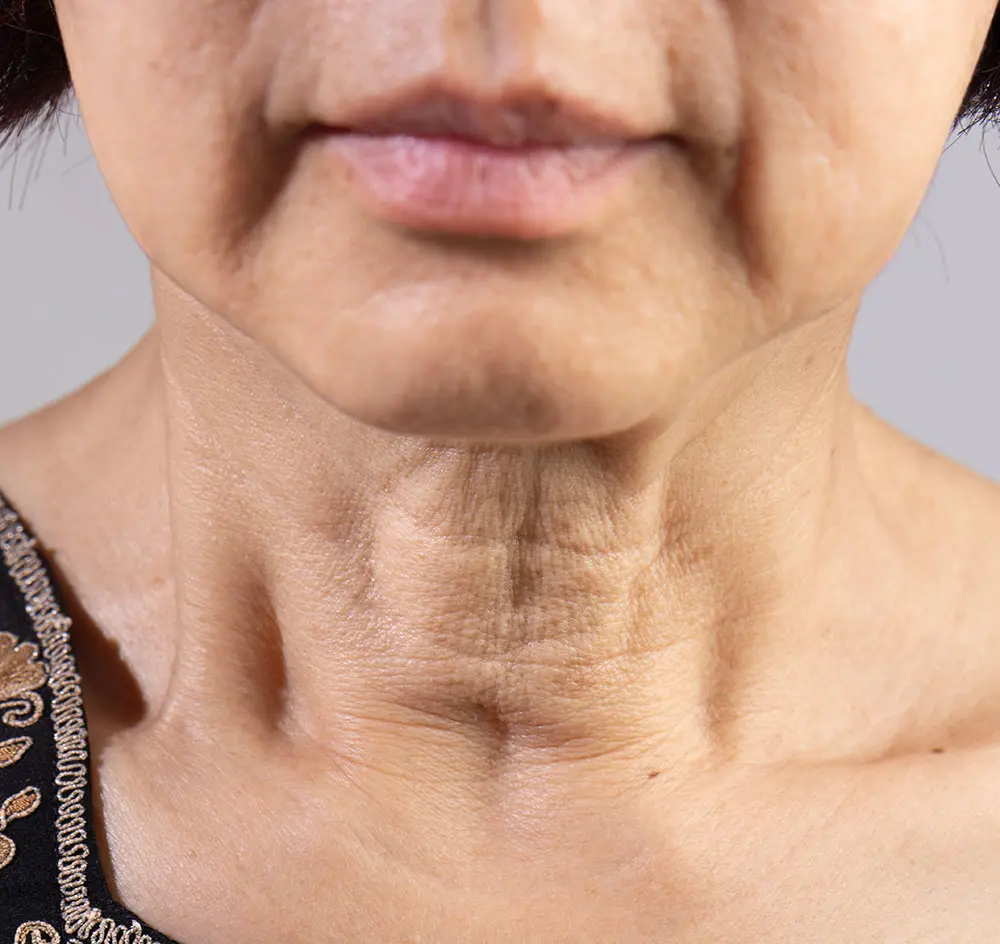 Platysmal Bands | Platysmal Bands Treatment | Platysmal Neck Bands