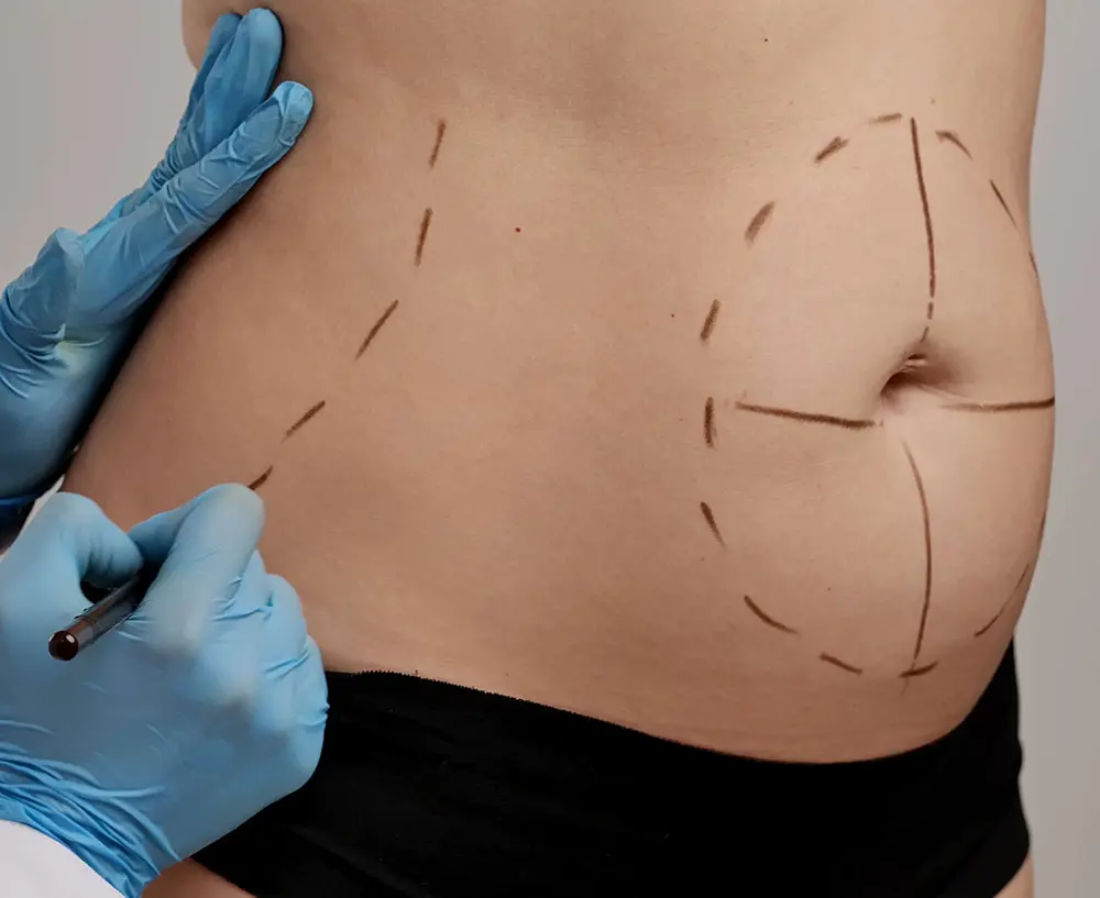 Vaser Liposuction UK | What is Vaser Liposuction | Vaser Liposuction Before and After