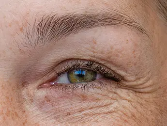 Crows Feet | Crows Feet Treatment | Crows Feet Wrinkles
