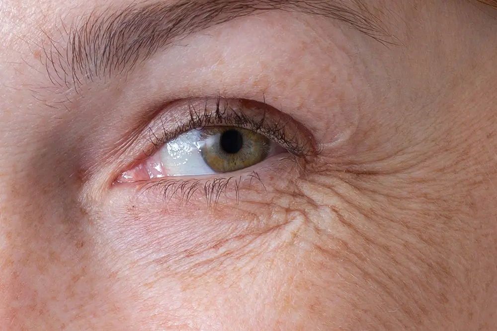 Crows Feet | Crows Feet Treatment | What Is Crows Feet