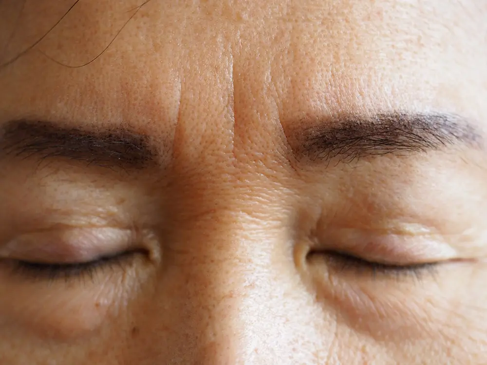 Frown Lines | Frown Lines Treatment | How to Get Rid of Frown Lines