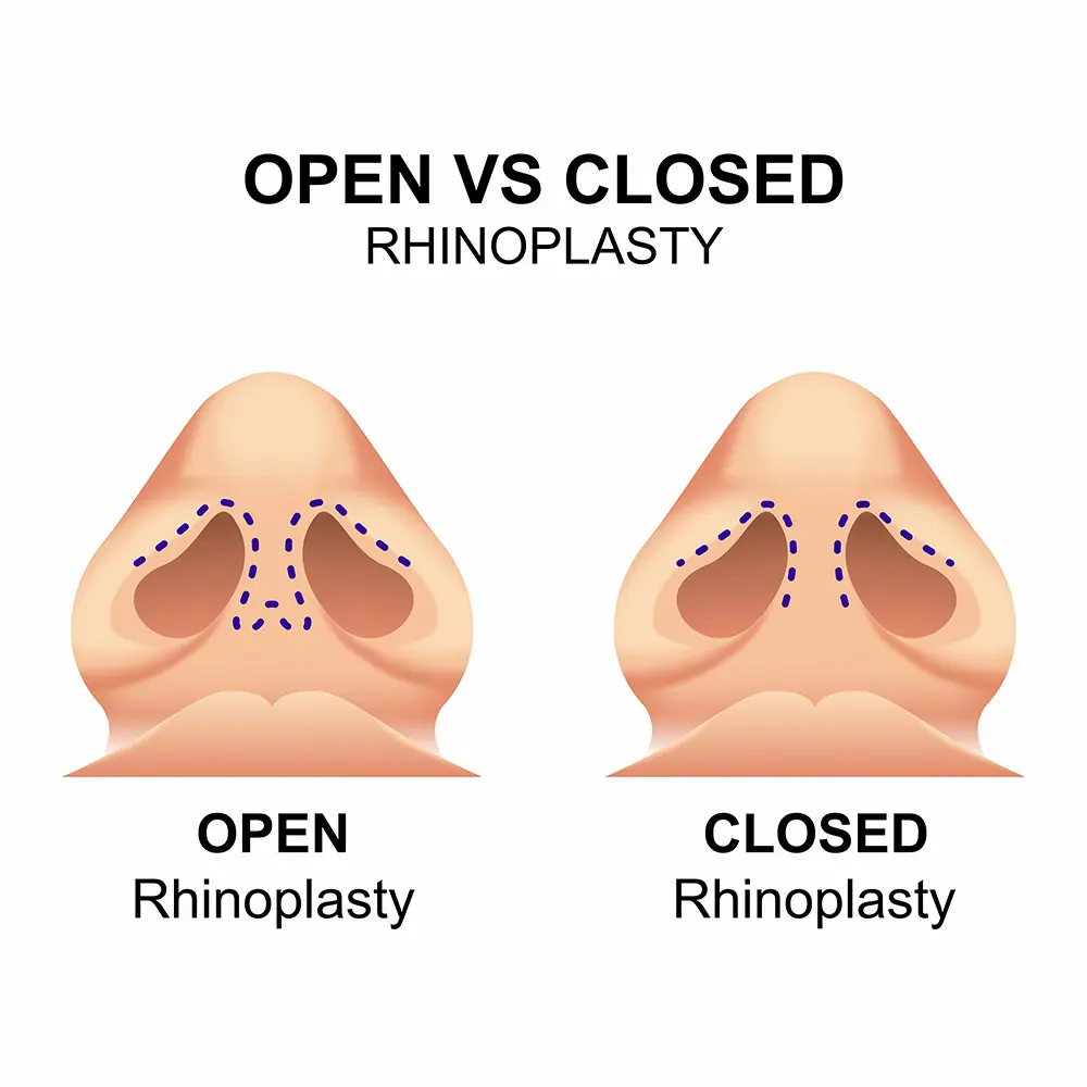 Open Rhinoplasty | Open Rhinoplasty Procedure | What is Open Rhinoplasty | Open Rhinoplasty Surgery