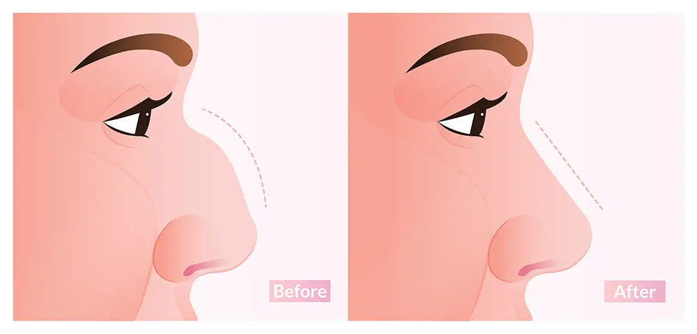 Preservation Rhinoplasty | What is Preservation Rhinoplasty | Dorsal Preservation Rhinoplasty | Preservation Rhinoplasty Cost