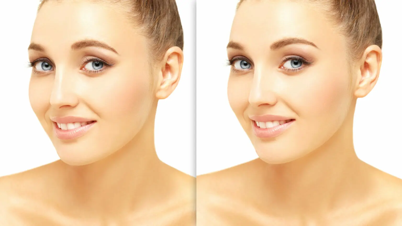 Before and After of a young woman with a brow lift