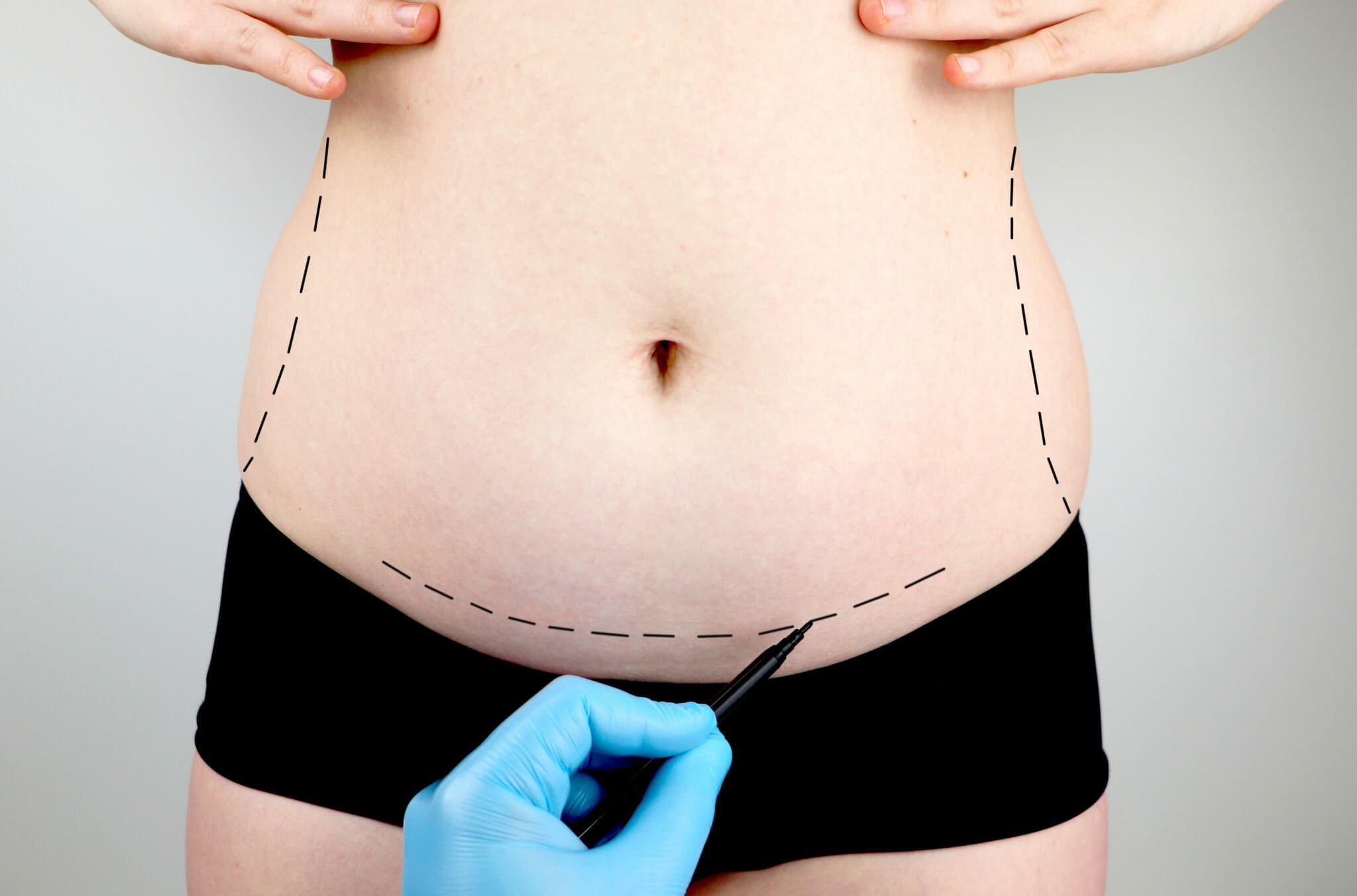 tummy tuck recovery pain